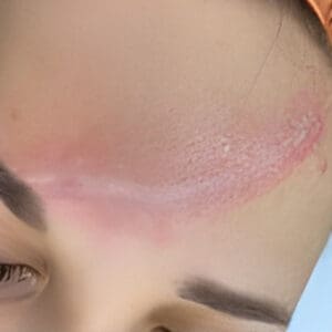 Before NeoGen plasma skin rejuvenation showing wrinkles, pigmentation, or skin laxity in Louisville