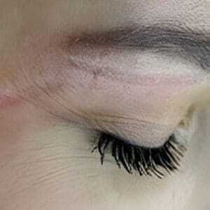 Before NeoGen plasma skin rejuvenation showing wrinkles, pigmentation, or skin laxity in Louisville