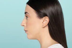 Facial profile after Restylane Defyne treatment with improved balance