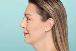 Facial profile after Restylane Defyne treatment with improved balance