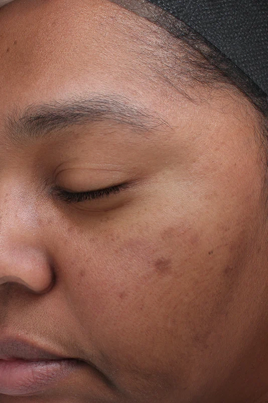 After VI Peel Purify with Precision showing clearer skin and reduced acne discoloration in Louisville