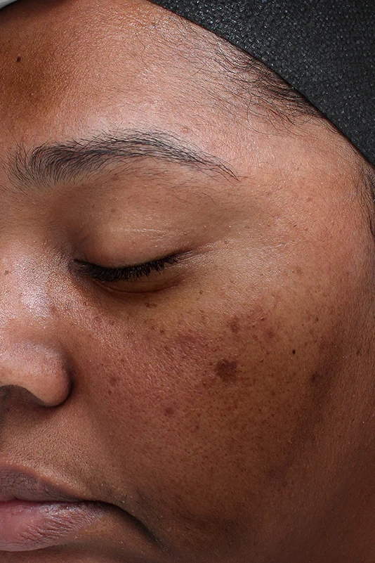 Before VI Peel Purify with Precision showing active acne, oiliness, and post-acne pigmentation in Louisville