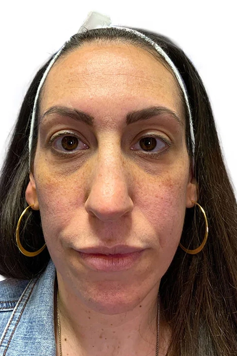 Before ToxBooster treatment showing wrinkles, sun damage, and uneven skin tone in Louisville