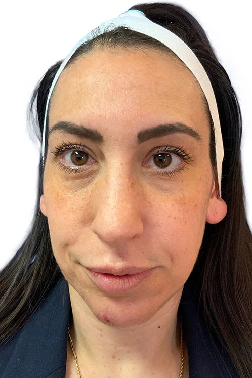 After ToxBooster treatment showing smoother wrinkles and brighter, more even skin in Louisville