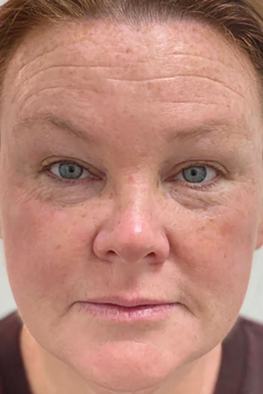 Before ToxBooster treatment showing wrinkles, sun damage, and uneven skin tone in Louisville
