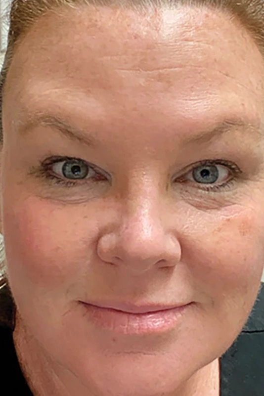 After ToxBooster treatment showing smoother wrinkles and brighter, more even skin in Louisville