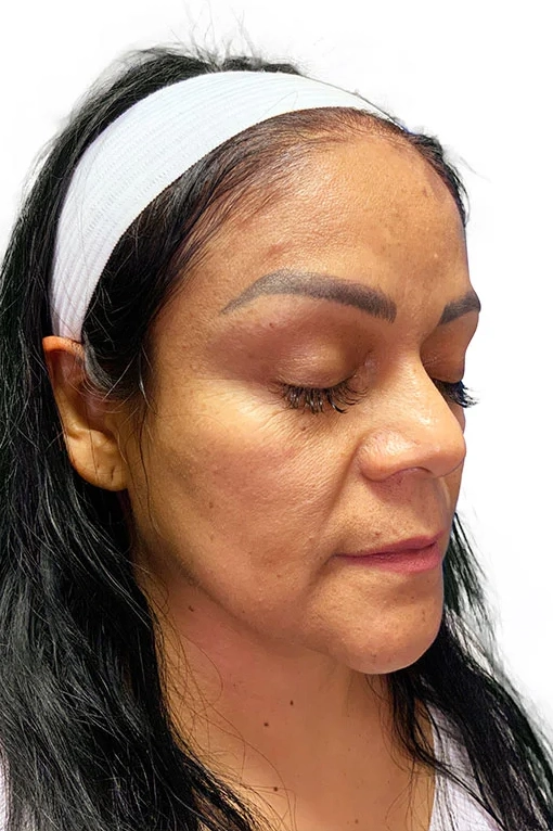 Before ToxBooster treatment showing wrinkles, sun damage, and uneven skin tone in Louisville
