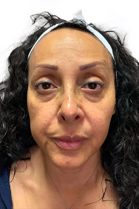 Before ToxBooster treatment showing wrinkles, sun damage, and uneven skin tone in Louisville