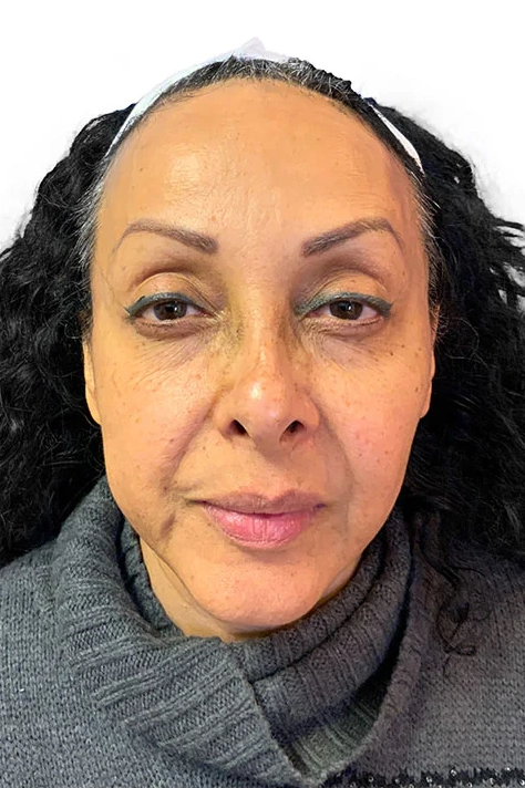 After ToxBooster treatment showing smoother wrinkles and brighter, more even skin in Louisville